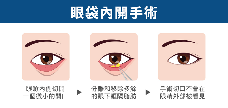 消除眼袋手術方式比較，內開眼袋手術