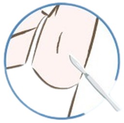 頂漿腺刮除手術，通過切除腋下的頂漿腺以減少流汗，從而改善狐臭症狀
