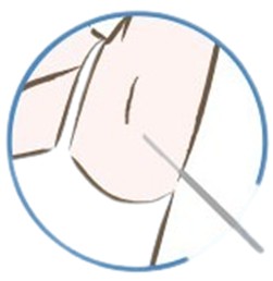 微創螺旋刀，以微創手術在腋下開小切口的方式進行，雖然比起傳統大範圍開刀傷口範圍比較小能減少對周圍組織的影響