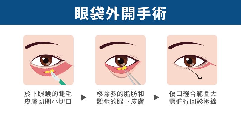 消除眼袋手術方式比較，外開眼袋手術